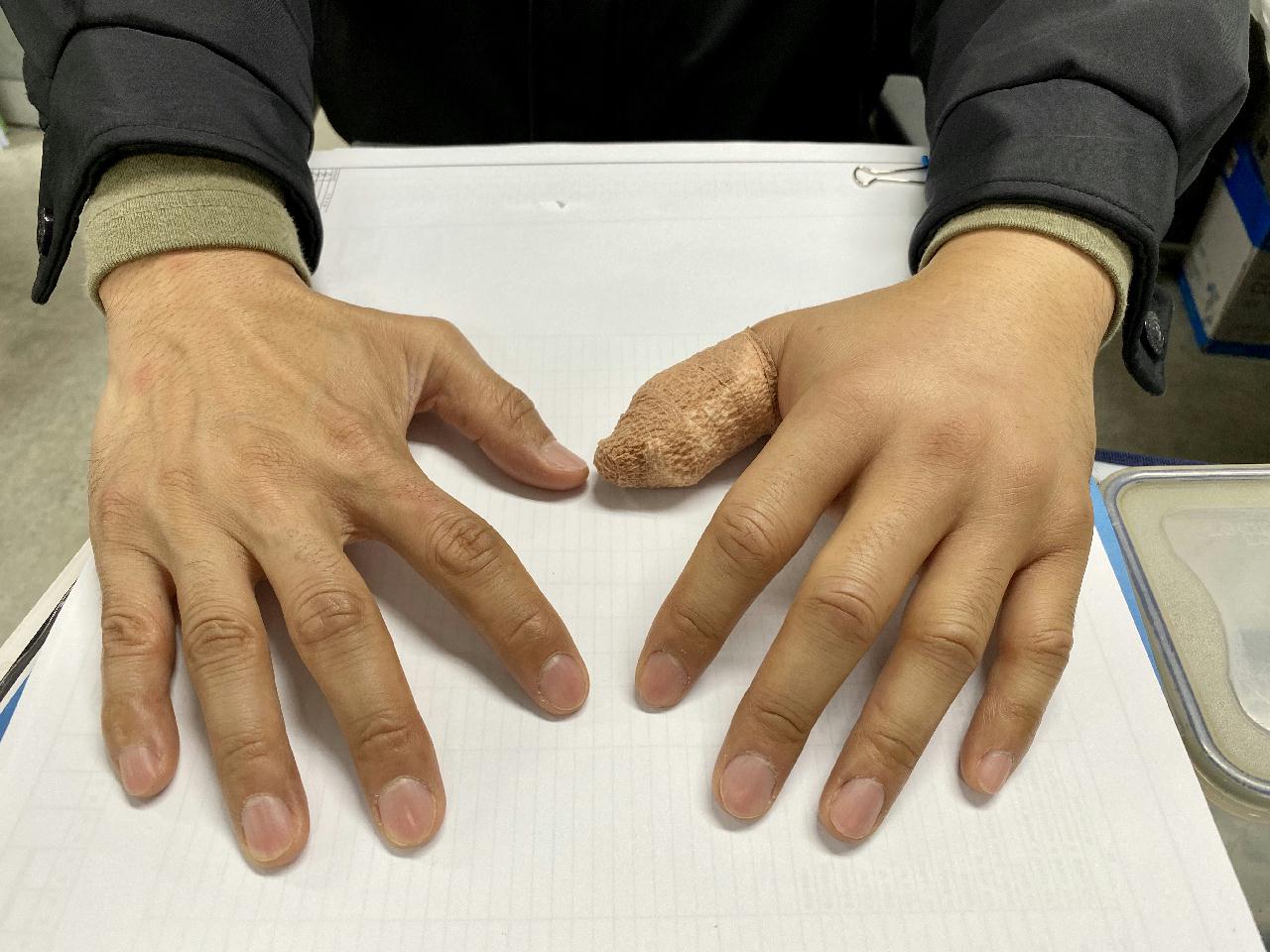 사량도 2번째날...쑤기미에 쏘이다